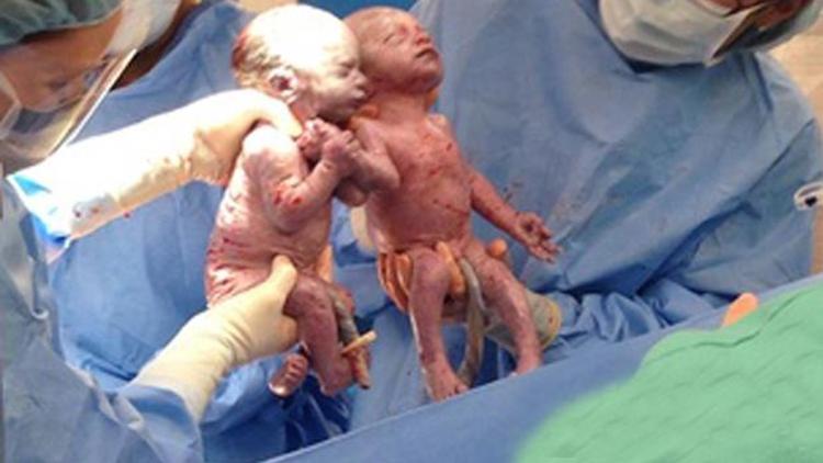 İkizler el ele doğdular