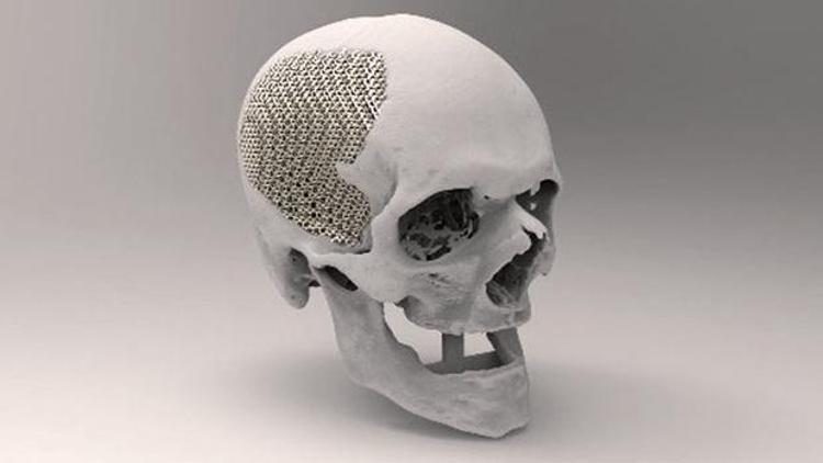 Yerli malı 3D protez