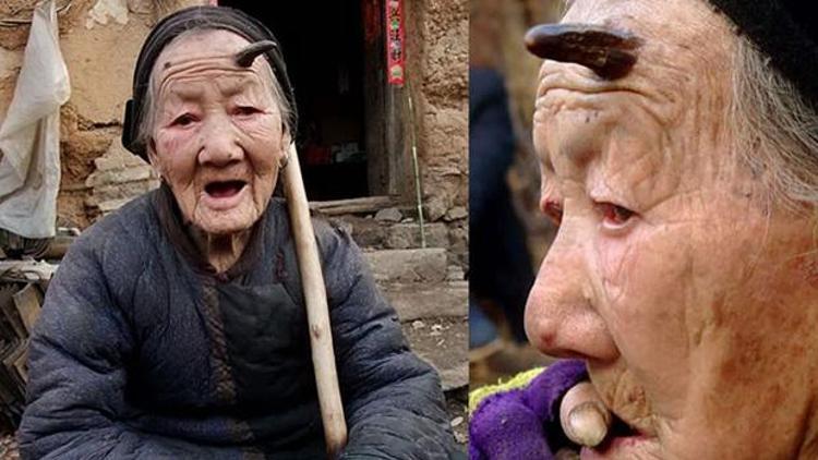 101 yaşında kafasında boynuz çıkan kadın