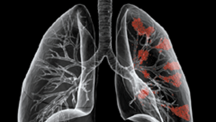 Akciğer kanserinde yeni umut