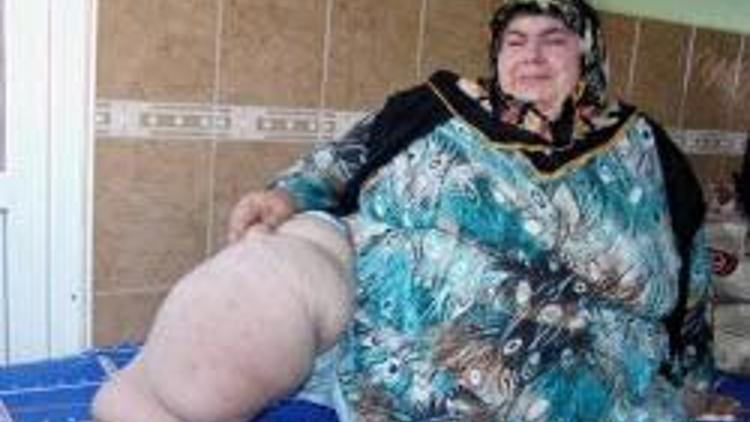 “Obezite hastası” kadın, 260 kiloya ulaştı