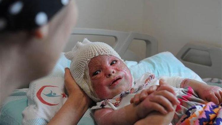 Isınmak için ateş yakmaya çalışırken yaralanan Suriyeli kadın ve bebeği iyileşti