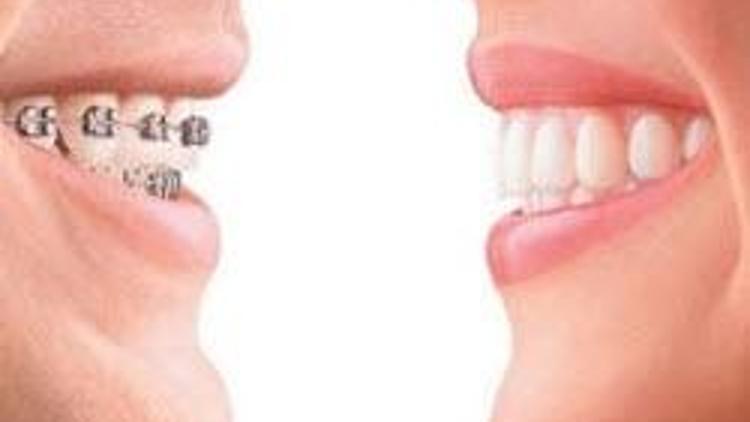 Çarpık dişlerin telsiz tedavisi artık mümkün