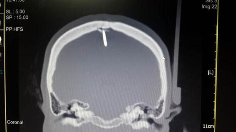 Kafatasında 2,5 santimlik çiviyle 2 gün yaşadı