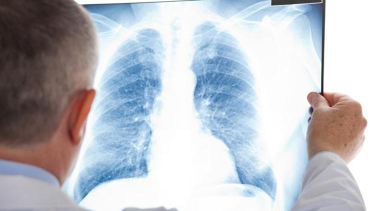 Akciğer kanseri korkutan boyutlara ulaştı