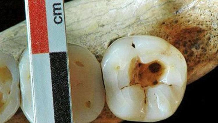 14 bin yıl önce dişçiye gitmiş