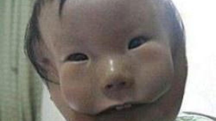 İki yüzlü bebeğin maskesi ameliyatla çıkarılacak