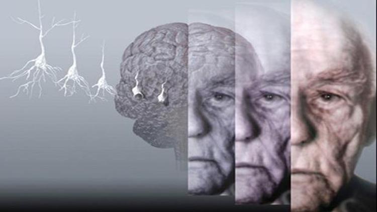 Ameliyat sırasında Alzheimer “kapmak” mümkün olabilir
