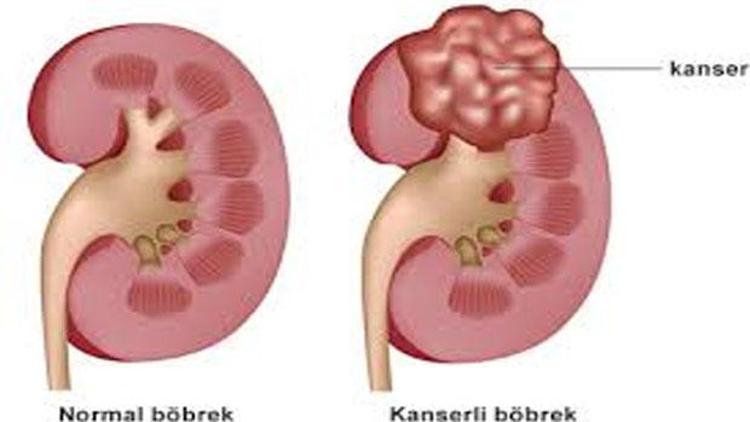 Böbrek kanserinde yeni umut