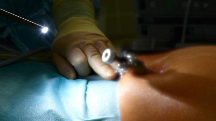 Prostat kanseri cerrahisinde en iyi çözüm: Laparoskopik ameliyat