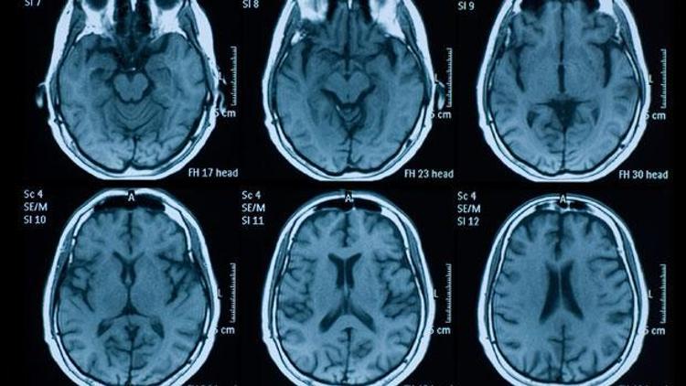 Transseksüel gencin beyin MRı doktorları şaşırttı