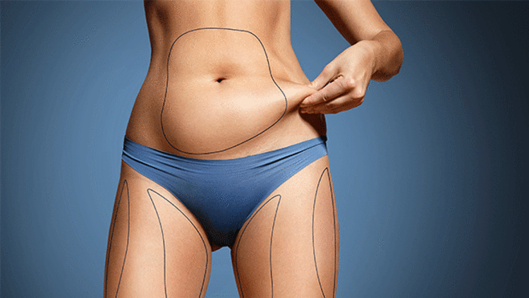 Lazer lipoliz ve  liposuction arasındaki fark nedir