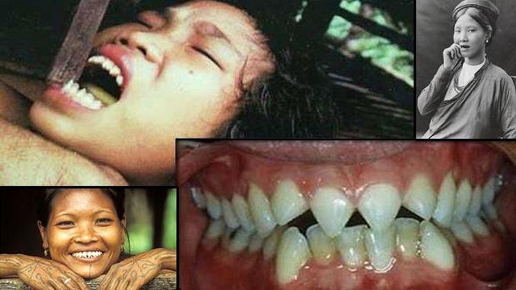 İnsanlar neden dişlerini sivriltir