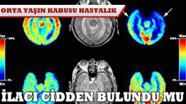 Alzheimerın ilacı cidden bulundu mu