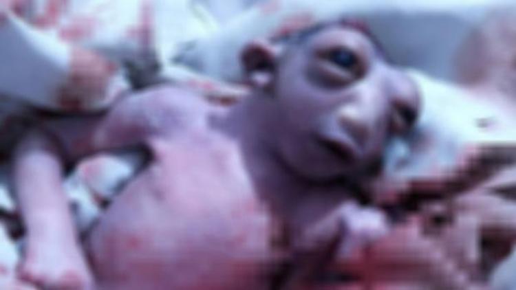 Başının bir kısmı olmadan dünyaya gelen bebek hayatını kaybetti