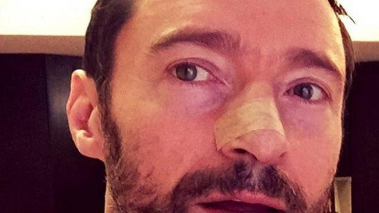 Hugh Jackman: Güneş kremi sürmezseniz benim gibi kansere yakalanırsınız