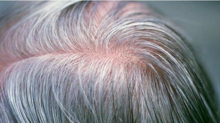 Saçların beyazlamasıyla bağlantılı olan gen bulundu
