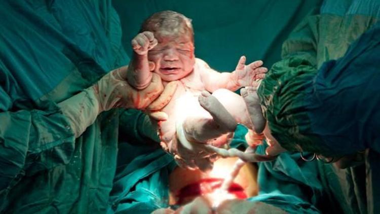 Yaşamayacak bebeği doğurmaya teşvik