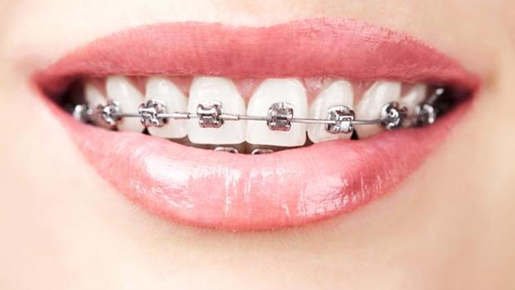 İleri yaşlarda diş teli taktırmak mümkün mü