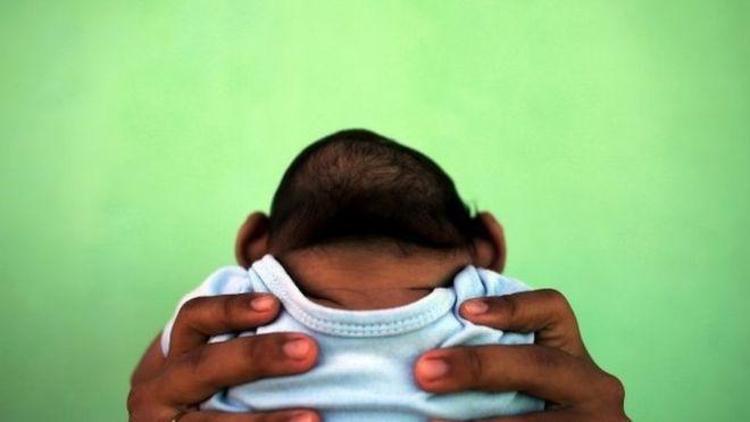 İspanyada ilk mikrosefali bebek doğdu