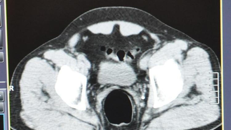 Böbrek kontrolünde fıkra gibi olay
