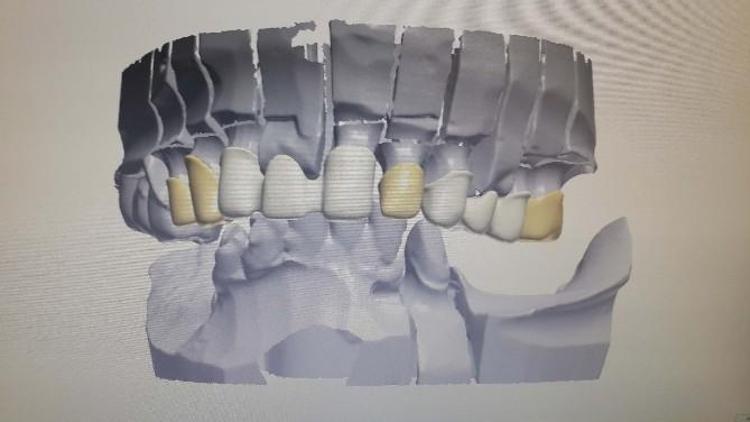 Diş Tedavisinde Bilgisayar Teknolojisi