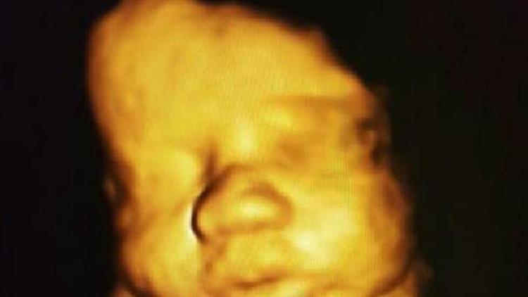 4boyutlu ultrasonla anne karnındaki bebeğin engelli olup olmadığı anlaşılabiliyor