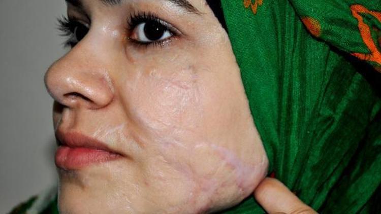 Yüzünden yaralanan Suriyeli Zehra estetik ameliyat olmak istiyor