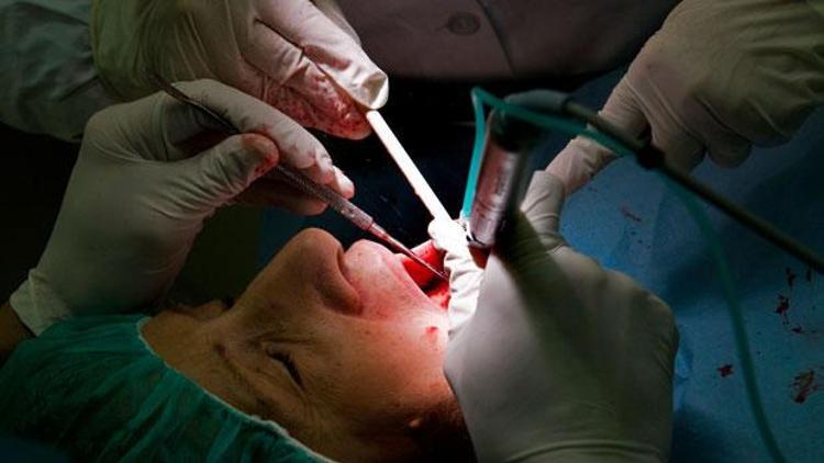 8den fazla diş dolgusu sinir sistemi hastalıklarına neden olabilir