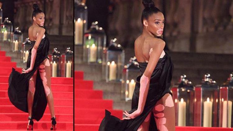 Winnie Harlow: Aslında gazeteci olmak istiyordu