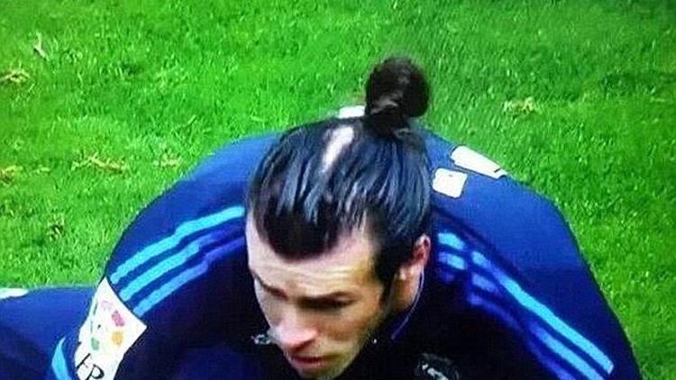 Gareth Bale saç ektirecek