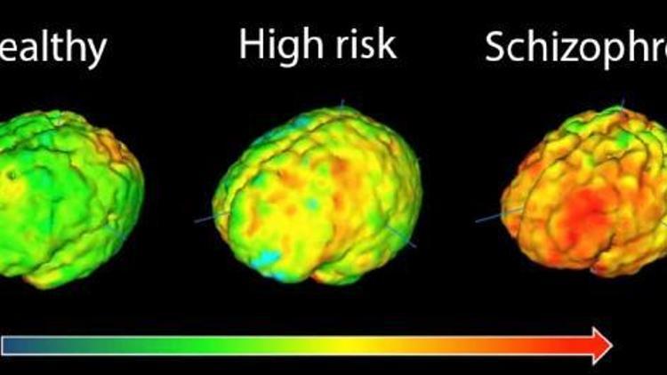 Şizofreni bağışıklık sistemi hastalığı olabilir
