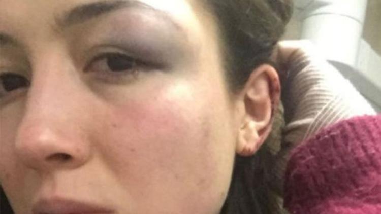 Genç kadından vahim iddia.. Barda demir çubukla dövdü