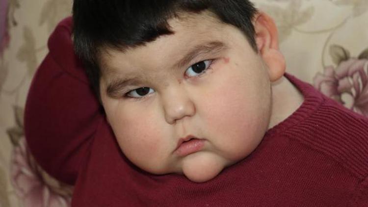 2 yaşında 37 kiloluk Yağız, devlet desteğiyle kilo vermeye başladı