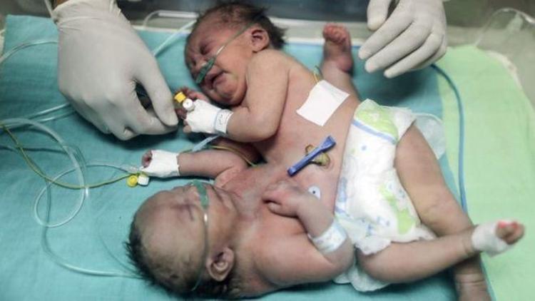 Gazzeli yapışık ikizler Suudi Arabistandaki ameliyatla ayrıldı