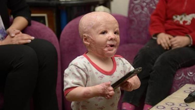 Bebek arabasında yanan 2 yaşındaki Ahmet’in tedavisi için kampanya başlatıldı