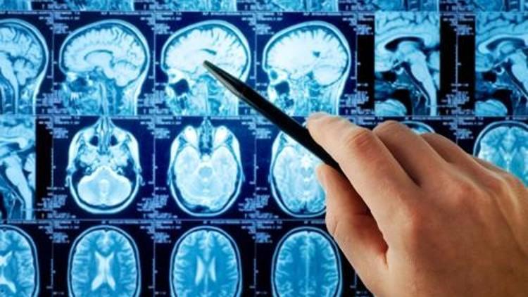 Beyin tümörleri hakkında herkesin bilmesi gereken 5 şey