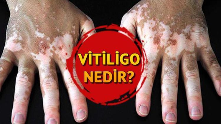 Vitiligo nedir Vitiligo belirtileri ve tedavisi