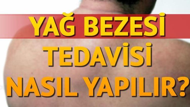 Yağ Bezesi nedir Yağ Bezesi nasıl geçer