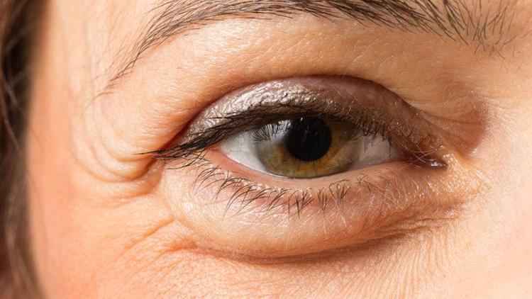 Nefrotik sendrom nedir Göz kapağı şişmesi neden olur