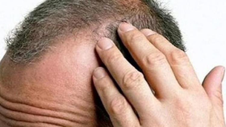 Saçkıran (Alopesi Areata) nedir