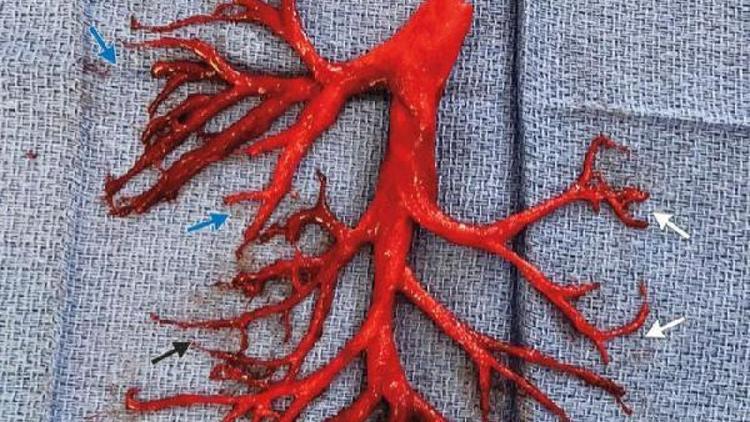 36 yaşındaki hasta ağaç dalı şeklinde 15cmlik kan pıhtısı tükürdü