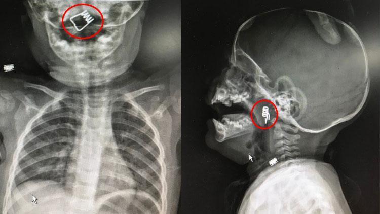 Korkunç 1 yaşındaki bebeğin boğazında tespit edildi