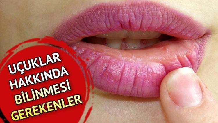 Uçuk nedir Uçuk neden olur ve nasıl geçer