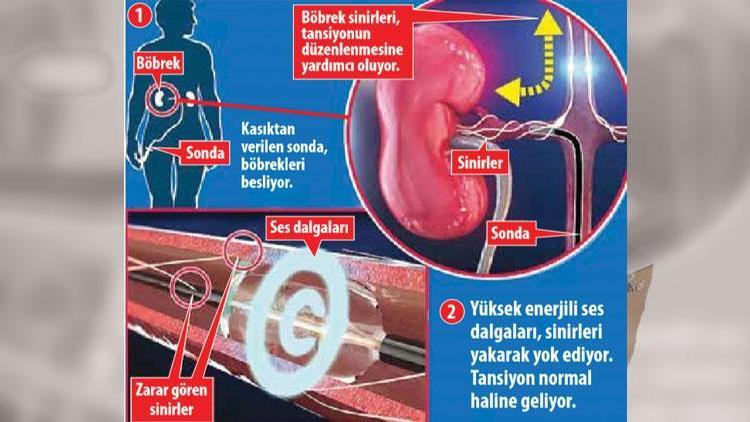 Ses dalgası tansiyonu düşürecek