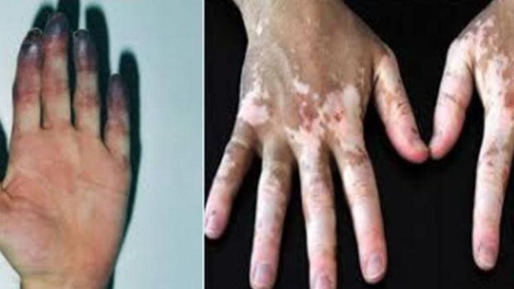 Beyaz parmak hastalığı (Raynaud Sendromu) nedir