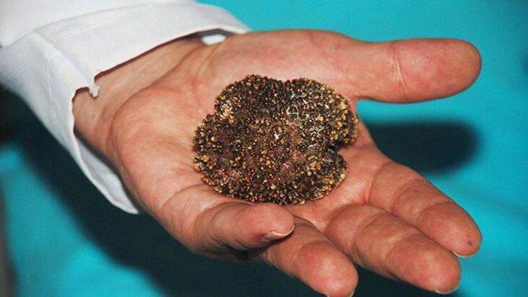 Diyarbakırda akılalmaz olay Mesanesinde 220 gramlık tek parça taş çıktı