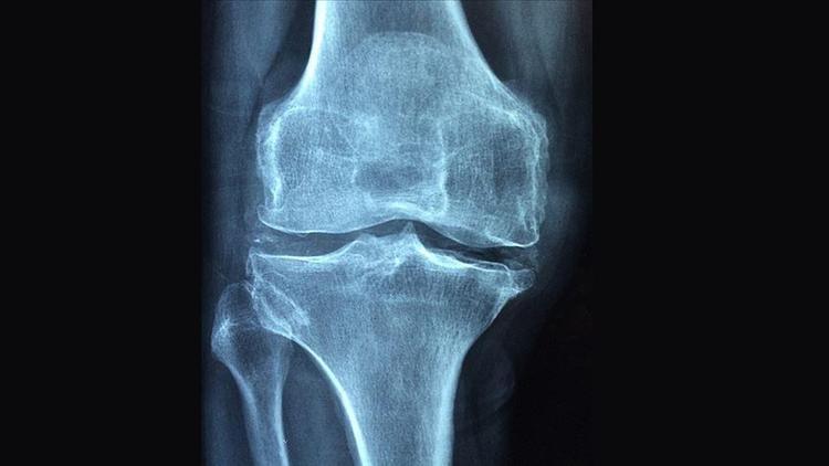 Osteoporoz nedir Osteoporoz belirtileri neler