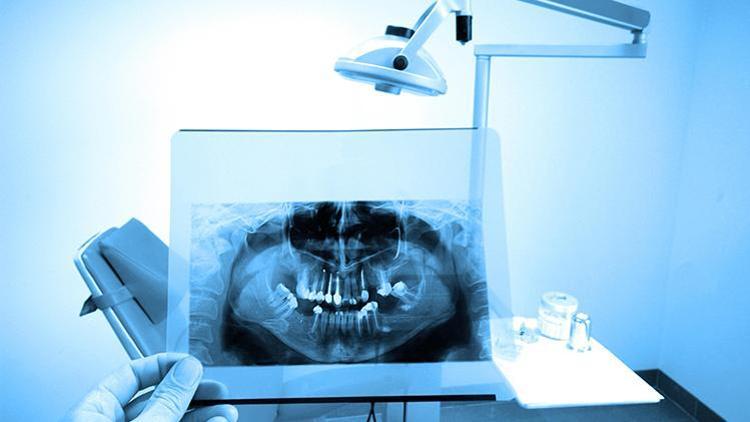 Diş Röntgeninde Radyasyon Miktarı Ne Kadar?