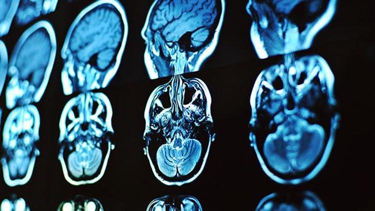 100 saat MRda kalan insan beynine en detaylı bakış